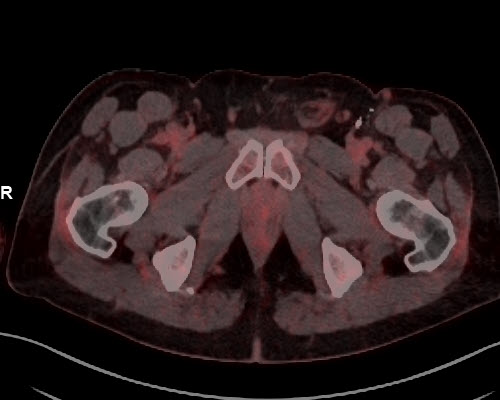 Melanom-Metastase in der Leiste links nach Therapie